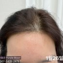 사람들이좋은집 | 부산 탈모앰플 아무거나 쓰지 마세요, 효과 본 사람들이 실제 쓰는 후기 많은 제품 공개