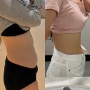 진주사 | 압구정피부과 온다리프팅 + 지방분해주사 내돈내산 후기