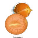 망막전막증 증상 및 수술 (황반주름, 유리체절제술) 이미지