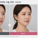 닥터디자이너의원 동탄점 | 여의도 실리프팅 후기 많은 이유, 자연스러운 리프팅 변화