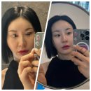40대 팔자주름 쥬베룩볼륨 대박 효과 후기