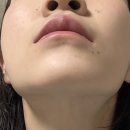 릴리 | [경기/성남] 분당정자역피부과 릴리톡스 시술 후기