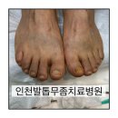 인천노인전문병원 | 인천발톱전문클리닉 후기 │ 송도발톱전문병원 치료로 양발 관리하고 달라진 변화