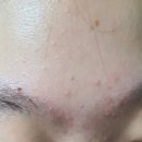 천연제품 | 중학생 여드름 화장품 추천 제품 후기 천연성분이라 대박 순함