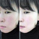 천안피부관리 케이엠에스테틱 다녀온후기