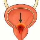 일중한의원 | 방광염 생리 끝나고 찾아온다? 어떻게 관리할까
