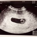 대구정신병원 | 임신기록 ~6주차 : 피검통과, 아기집 ,난황 확인 (대구차병원 성공 후기)