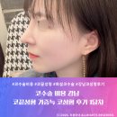 커넥트코 | 코수술 비용 강남 | 코끝성형 기증늑 코성형 후기 1달차