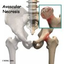 (주)대한한방 | 대퇴골두괴사(AVN)를 수술까지 가지 않도록 관리하는 강동구 한방병원 치료