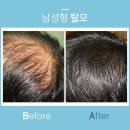 크로마흐 주식회사 | 수원탈모관리 여성 남성 탈모유형에맞게!