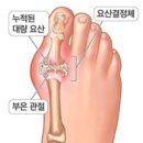 통풍 초기증상, 통풍치료에 좋은음식 이미지