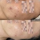 유경바이오 | 송파 여드름관리 라헨느스킨 2B알라딘바이오필 유경필링 후기
