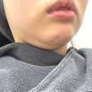 강남역 피부과 이중턱 심부볼 울쎄라 티타늄 60kj 통증 없음 내돈내산 후기