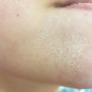 오페라연합의원 | 청주 피부관리 사창동 피부과 오페라 연합의원 알라딘필링 솔직후기