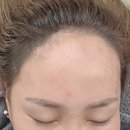 헤어로데오 | 압구정로데오피부과 헤어라인반영구 후기