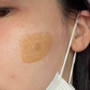 압구정의료기 | [공지] [ 압구정피부과 ] N년째 함께한 흑자제거 한 후기 리팟레이저 ( 가격 / 통증 / 관리 )