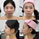 헤세라 | 1회차 비포애프터 찐후기! 기장윤곽관리 맛집 작은얼굴 탄력 리프팅 원하는 사람들, 여기로! 「헤세라」