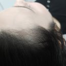 여성헤어라인시술 1회차후기 2회차후기