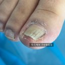 와이제이프라자 | 고척동 내성발톱 개선사례/퇴원 당일 바로 케어점 방문한 이유