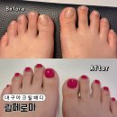 람페로마 | 대구 아크릴패디 수성못 네일샵 람페로마에서 발톱 성형 받은 후기