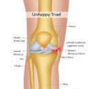 무릎 MRI (Knee MRI) 영상진단 이미지