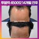 [50대 남자앞머리탈모 대량모발이식] 비절개 투블럭 4500모 1년 2개월 후기 (모엠의원/C자탈모/전지훈원장) 이미지