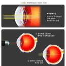 [국가건강정보포털]백내장 [cataract] 이미지