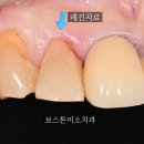 미소가있는보스톤치과의원 | 앞니 충치 치료방법, 레진, 크라운, 임플란트, 무보정 후기, 수원치과