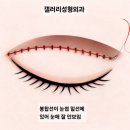 3377 | 대전 눈썹하거상, 처진 눈 개선 후기 | 갤러리성형외과