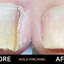 홀드핀칭 이미지