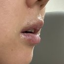 멍이랑 양이랑 | 김송이 클리닉ㅣ입술 필러 후기 + 리터칭 추가