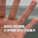 송피부과의원 | [서울/강남구] 청담동 읻다의원 :: 손가락 미니 타투 2차 제거 후기, 1차시술 2차시술 비교