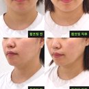 호야 | 대전 윤곽관리 확실한 곳 호야뷰티 내돈내산 후기