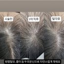 평택 smp 추천 [더채움], 여성 가르마 두피시술 전후비교(3회차 내돈내산 보정×)
