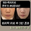 서구-01-22 | [대전 아이엠피부과 솔직 후기] 기미치료 후 3년, 다시 써보는 후기