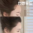 잠실 헤어라인 반영구 문신 [인앤무드] 대만족 후기