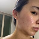 진가정의학과의원 | 이삭가정의학과의원 편평사마귀 제거 후기 / 편사제거 / 4일차부터 7일차까지
