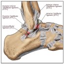 청담리온정형외과의원 | 발목 인대 수술, 브로스트롬(Brostrom,MBO) 수술만으로 충분할까?(Broström repair vs Suture tape...