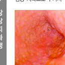 위염 위궤양 차이를 확인한 후 관리해 보시기 바랍니다 이미지