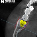 [ 천안 치과추천 ] 수평매복 사랑니 발치 후 음식물 끼임 개선되었던 20대 남성분 치료 후기