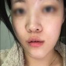 주걱집 | 주걱턱 교정 후기, 친구들이 양악 했냐고 물어봐요