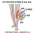 하지정맥류의 치료와 예방 이미지