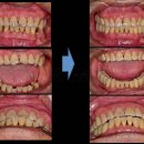 정 치과기공소 | 아산 온양 치과, 80대 전악 임플란트와 치아 교정을 동시에?? 가능할까요?