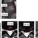 무흐흣 님의 요추디스크 L4-5, L5-S1의 MRI사진 판독입니다. (2007년도) 이미지