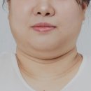 딩동멍 | 얼굴 람스로 이중턱 해결한 찐 1년차 후기 (효과와 멍 통증은)