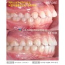 보우치과 네이버블로그