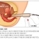 체외수정 시험관 과정 (난자 채취) 이미지