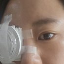 밀리3-172 | 인천 구월동 고도근시 렌즈삽입술 검사부터 수술까지 후기