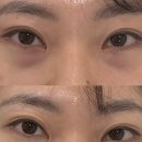 진다리로 | 광주 다크서클커버 오닛 ONIT 다크서클 눈밑관리