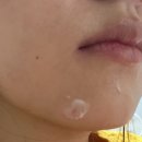 케어셀라 - 부산진구 | 여름철 트러블 진정 셀라듀 여드름크림 락토바이옴으로 피부 고민 케어 솔직 후기
